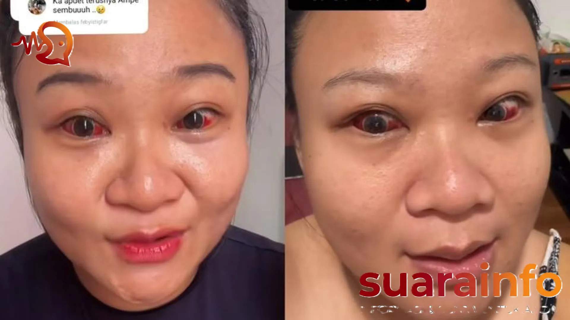 Mata Merah Usai Melahirkan: Fenomena Pecah Pembuluh Darah dan Mitos Mengejan yang Perlu Ibu Tahu