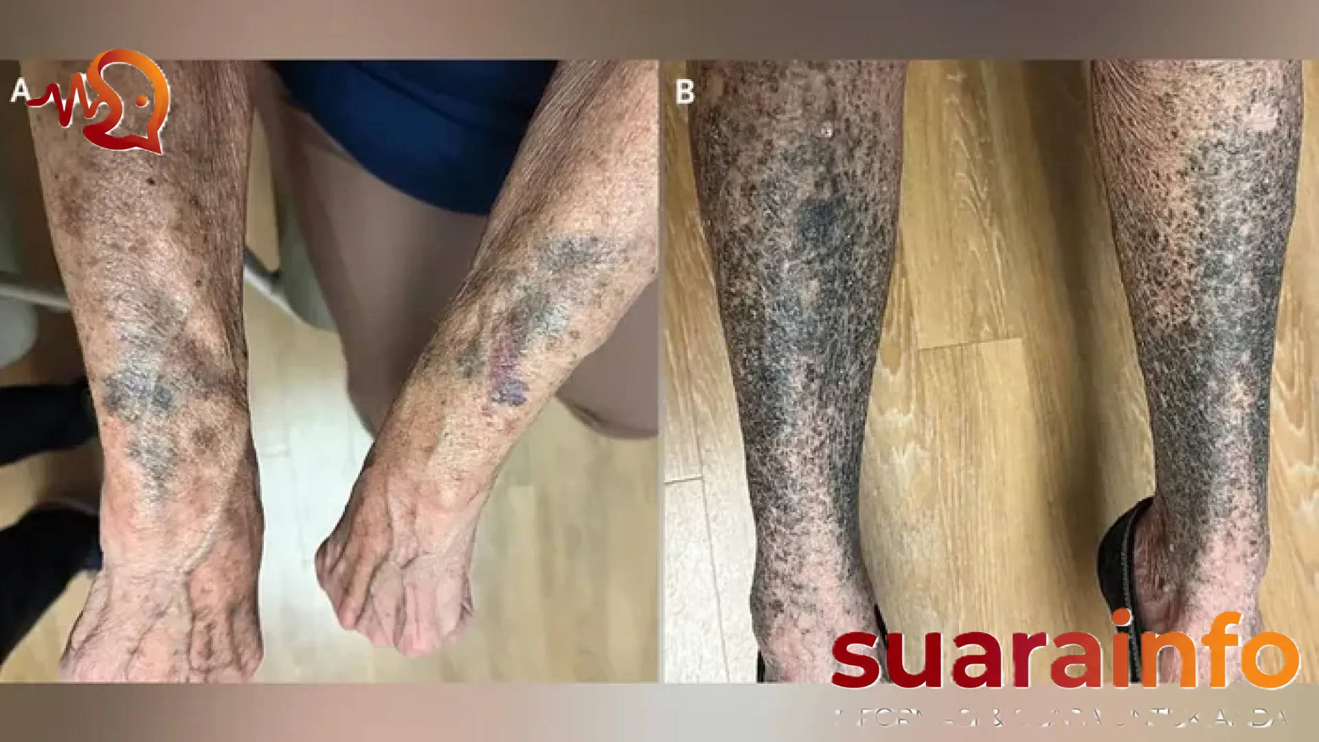Misteri Perubahan Warna Kulit Menjadi Hitam Akibat Efek Samping Antibiotik: Sebuah Kasus Medis Langka