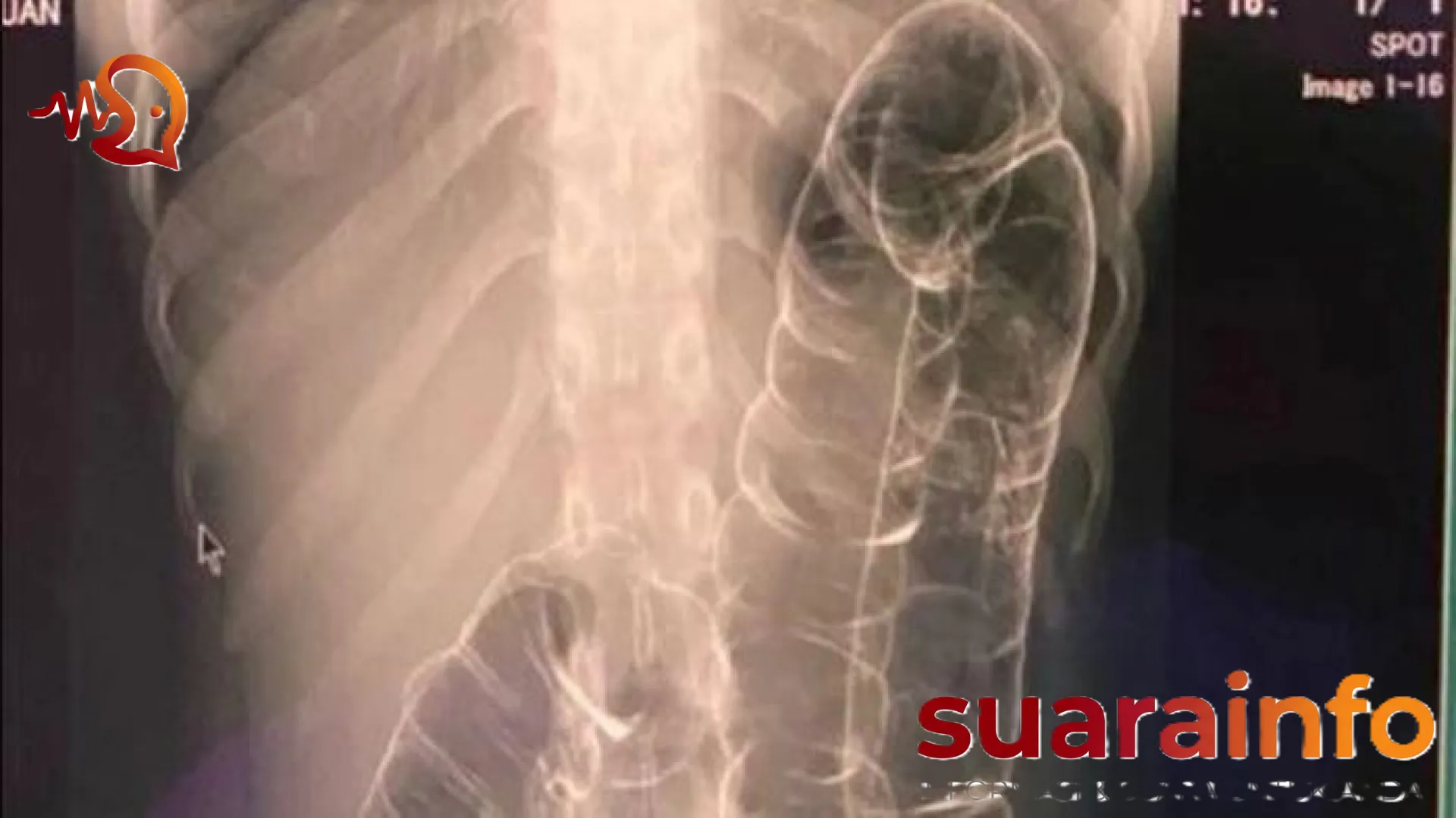 Viral Hasil Rontgen Usus Wanita yang Sembelit 23 Tahun: Fenomena Medis Langka yang Bikin Merinding