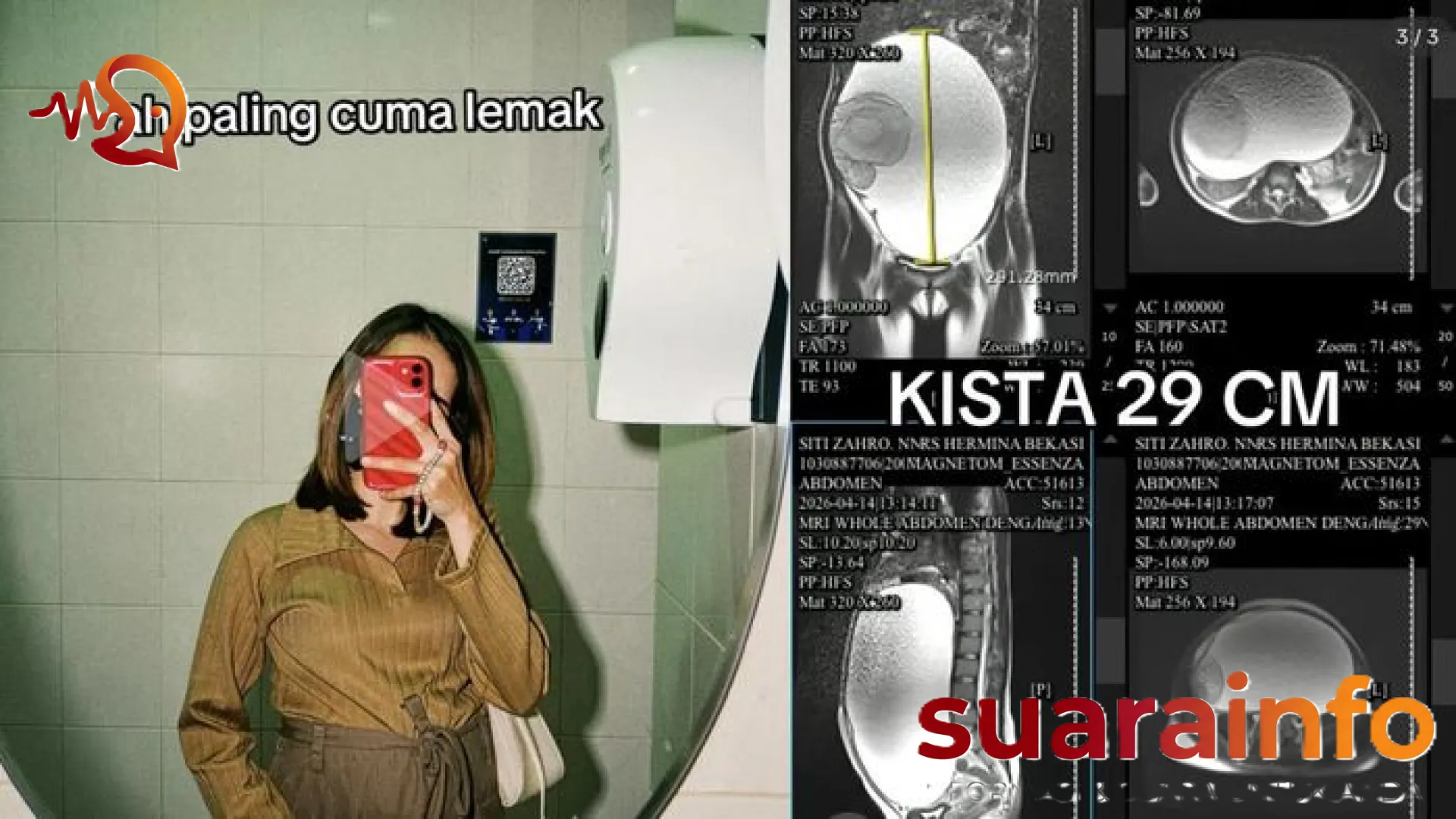 Viral Perut Buncit Dikira Lemak, Ternyata Kista Ovarium 29 Cm: Kisah Siti Zahro dari Bekasi